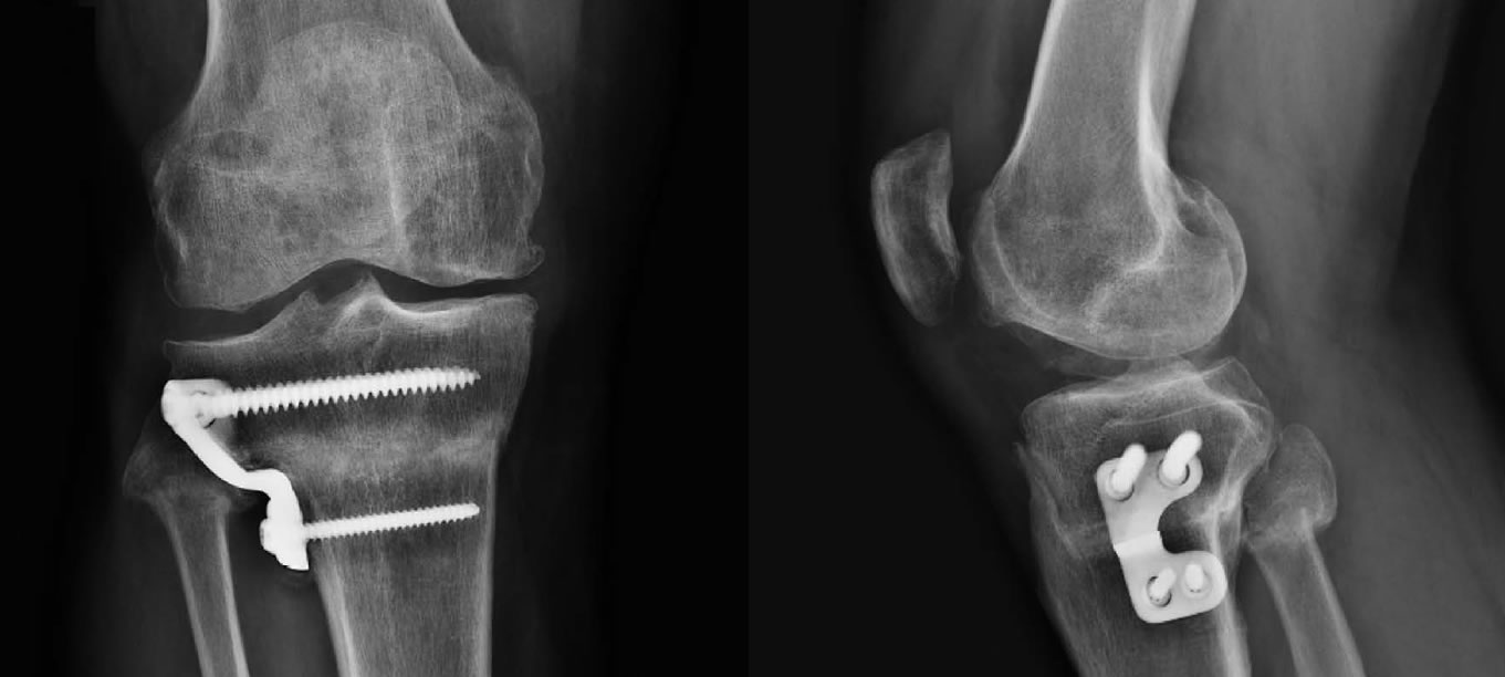 Uso de material de osteosíntesis personalizado impreso en 3D para osteotomía de rodilla