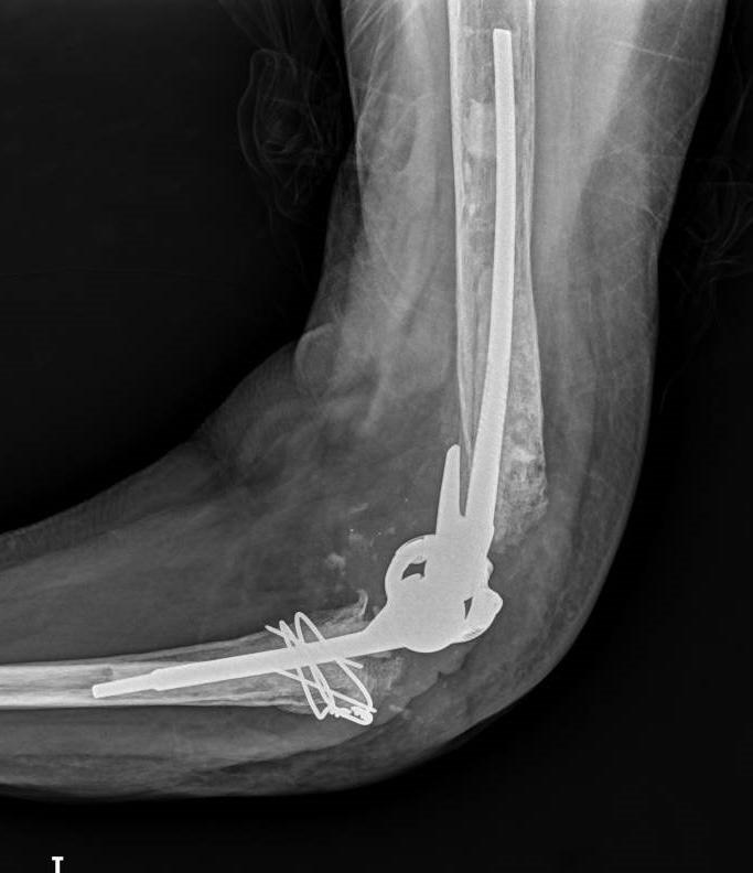 EL HOSPITAL FUNDACIÓN JIMENEZ DIAZ IMPLANTA CON ÉXITO UNA PROTESIS DE CODO A MEDIDA UTILIZANDO LA TECNOLOGIA 3D